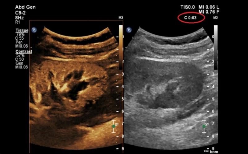 УЗИ с контрастированием